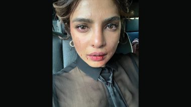 Priyanka Chopra Shares Picture of ‘Bruised’ Face From Citadel Set
